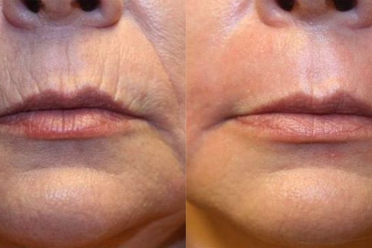 Plasma Fibroblast en párpados y abdomen