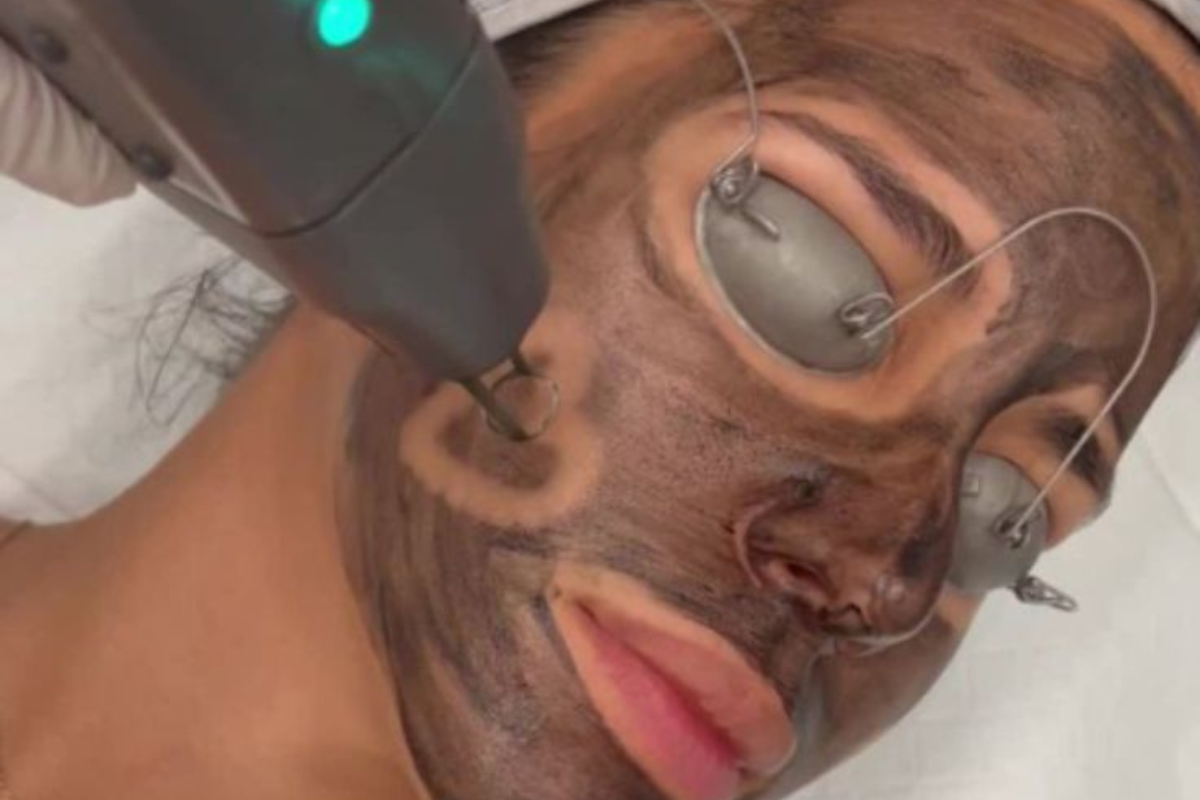 Facial Hollywood y peeling facial en Panamá