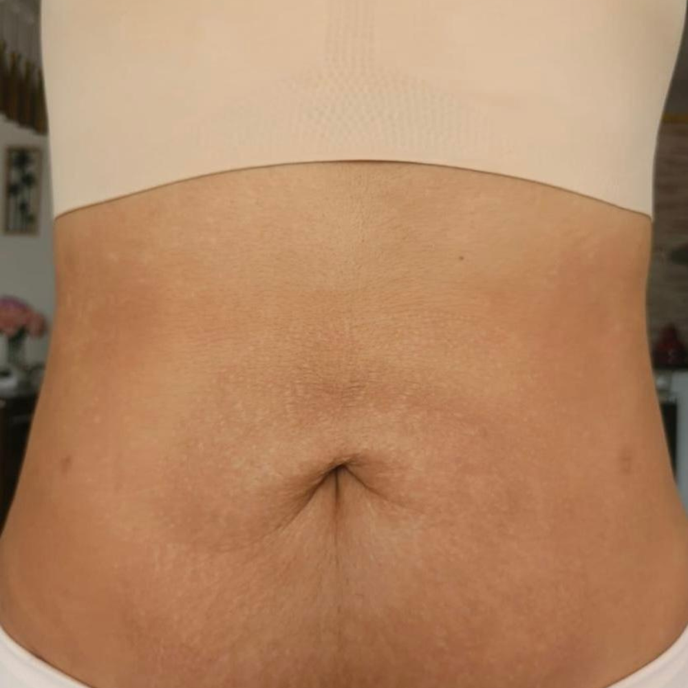 Tratamiento de abdomen en Figura Rostro KG