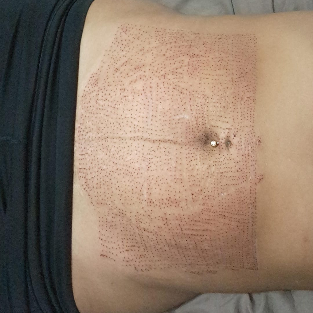 Hidrolipoclasia y tratamientos reductivos en Panamá