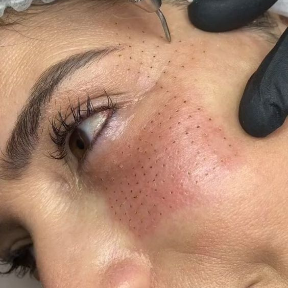 Equipo de tratamiento estético en Panamá