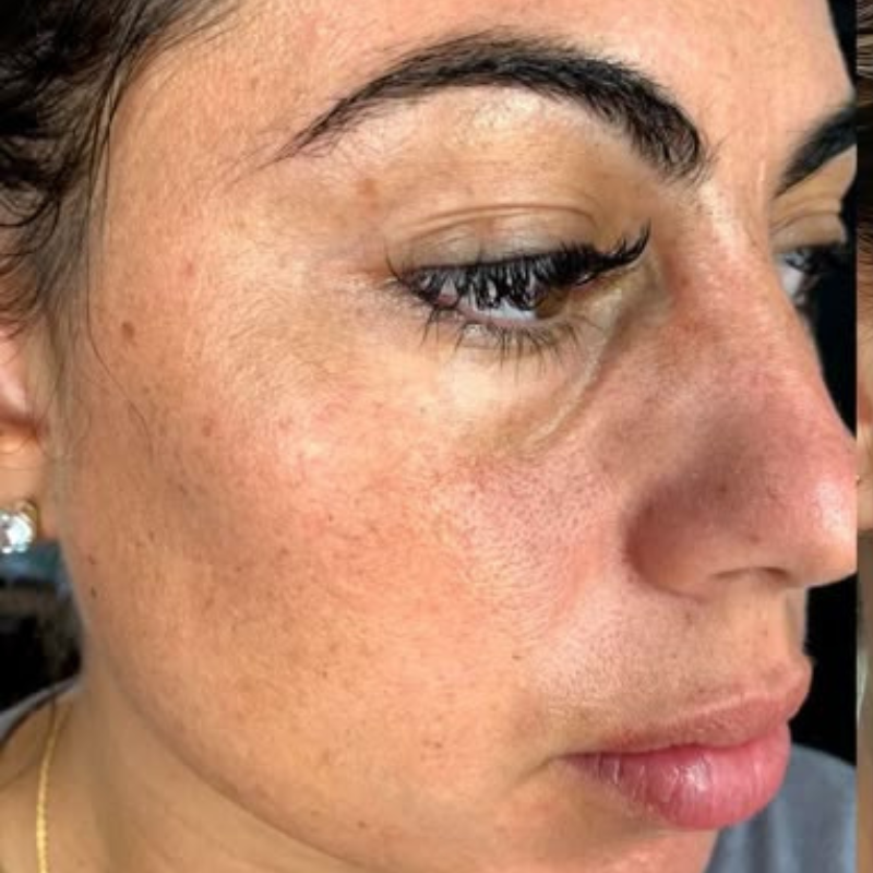 Antes Peeling Facial