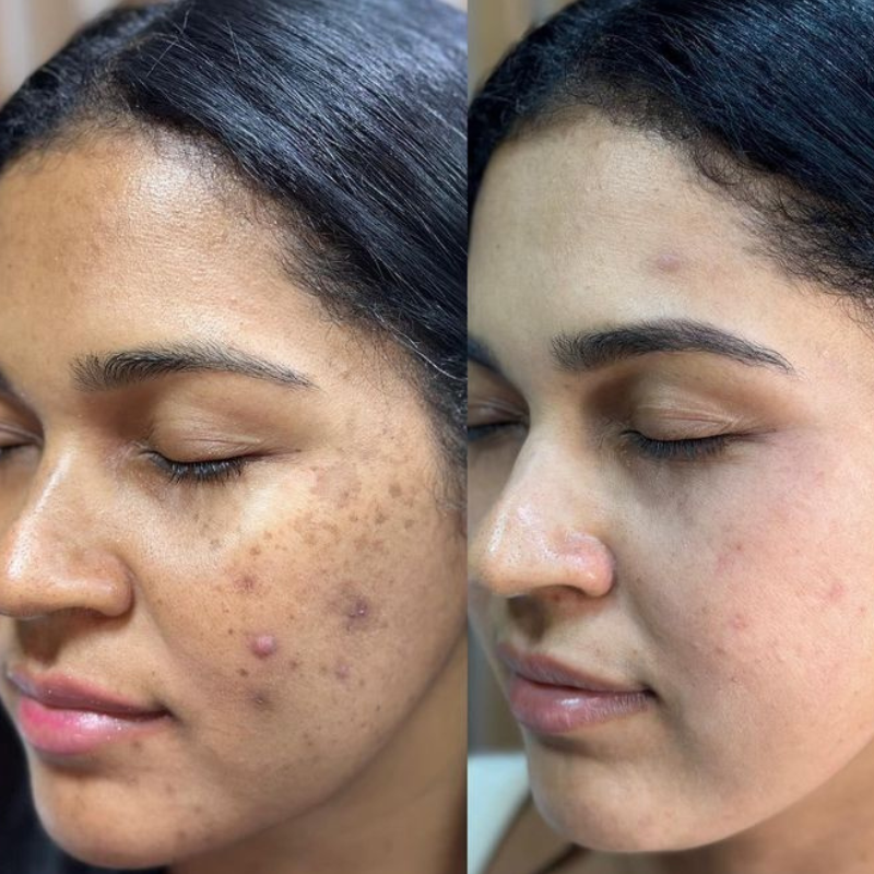 Después Peeling Facial