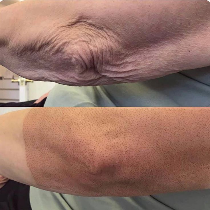 Flacidez en brazos tratamiento