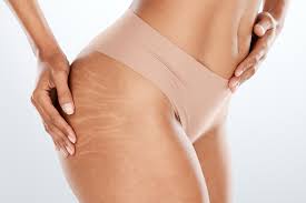 Plasma Fibroblast en glúteos